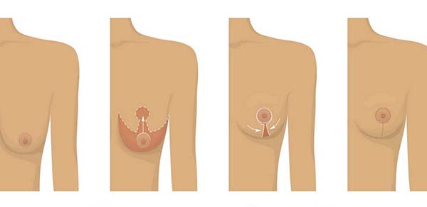 Những điều cần biết sau phẫu thuật nâng ngực