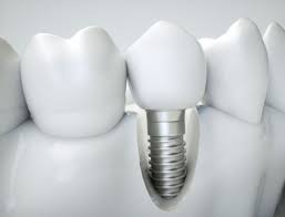 Các vân đề liên quan về hút thuốc và làm răng implant