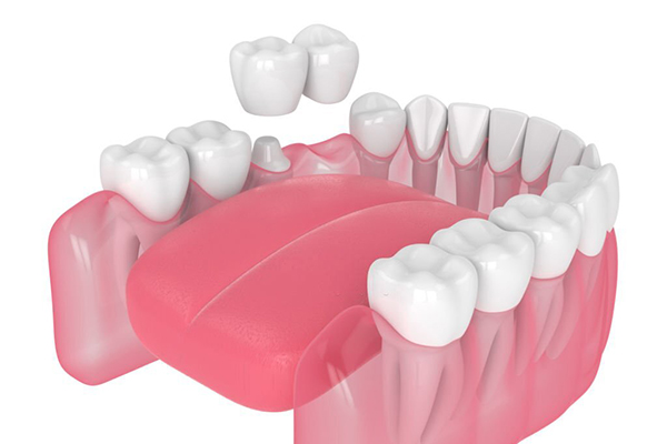 Kỹ thuật làm răng sứ sử dụng được bao lâu